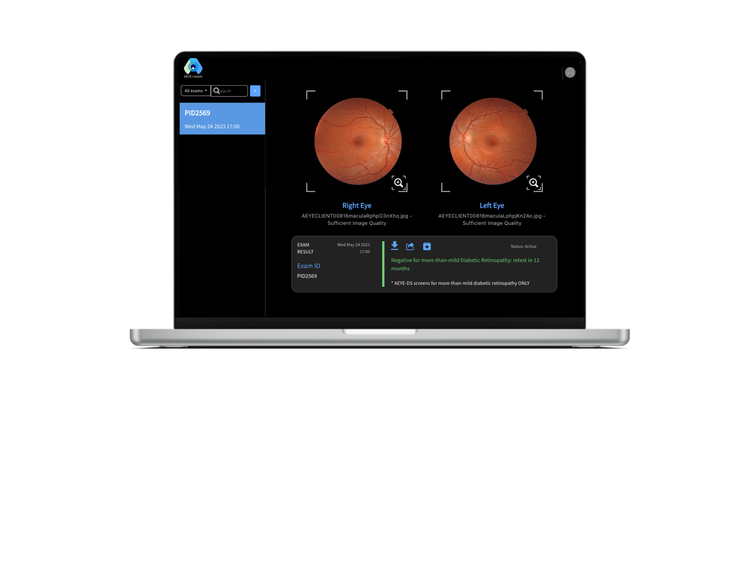 AEYE-DS screening interface displaying two retinal images and a negative result