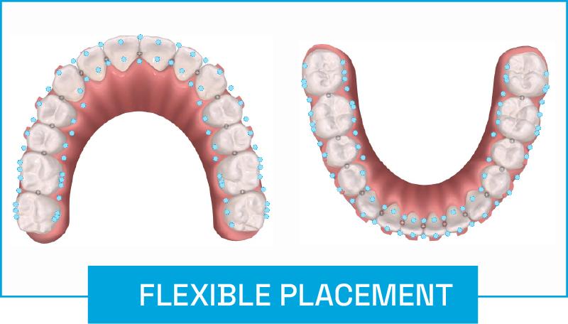 Angel Aligner diagram showing possible elastic button placements around upper and lower dental arches