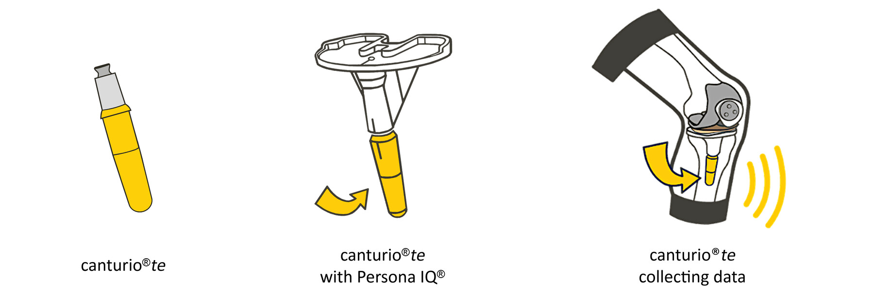 Canary Canturio smart tibial extension shown beside a knee implant