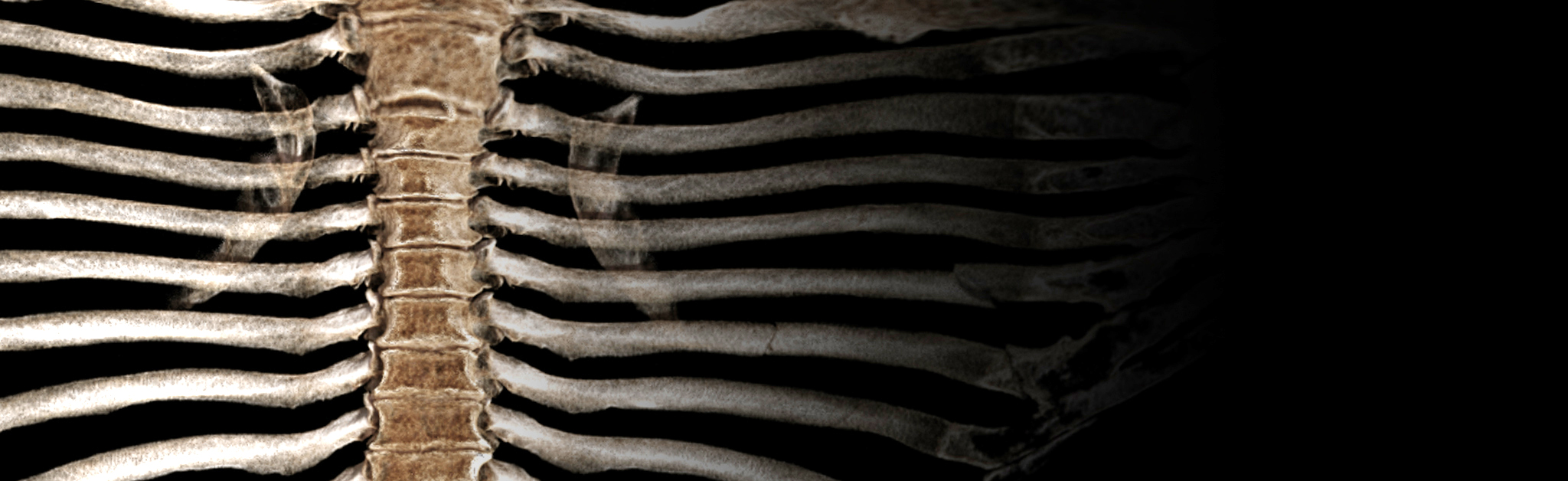 Vitrea Open Rib visualization showing the ribs in an unfolded view