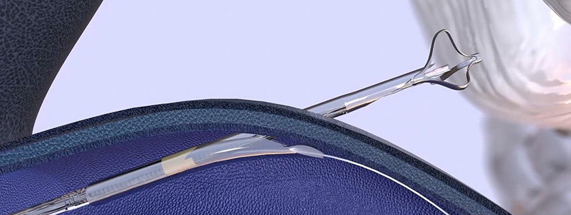 Illustration showing CereVasc eShunt catheter-based device components