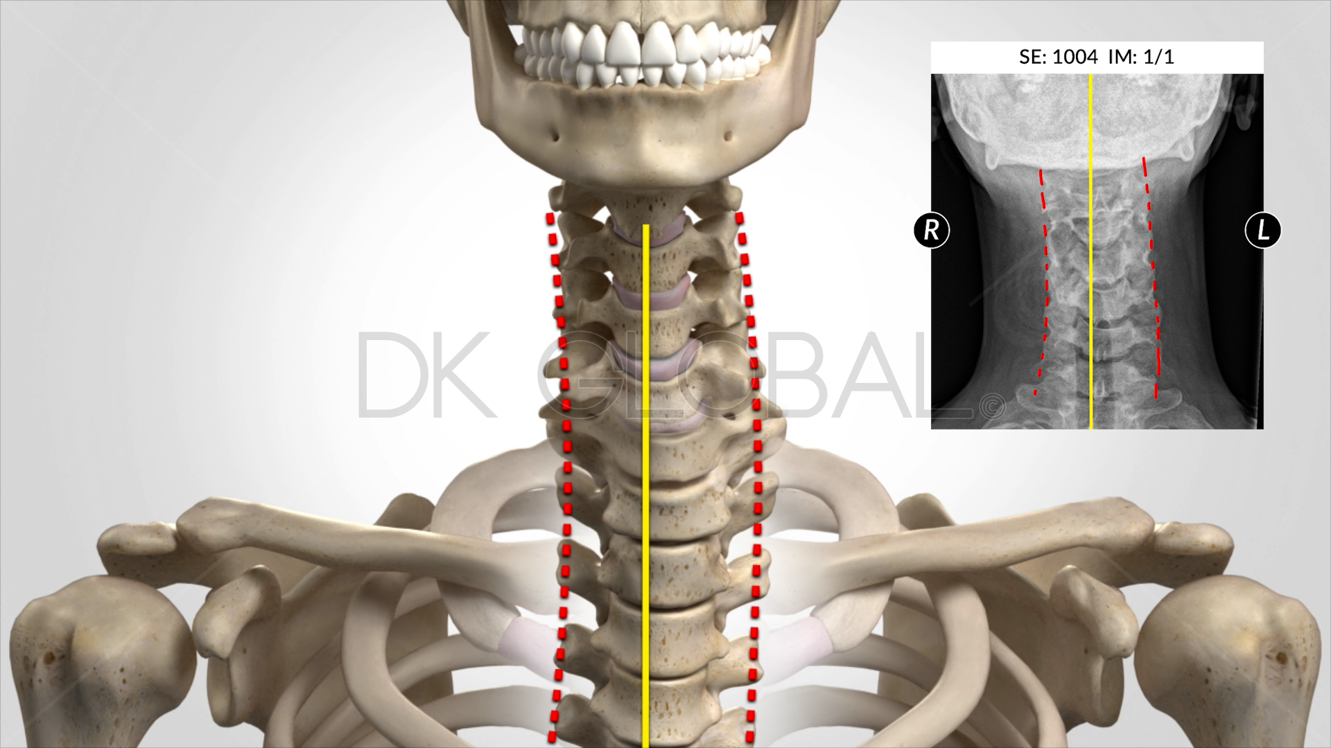 DK Global medical illustration comparing a three-dimensional cervical spine with an annotated medical image