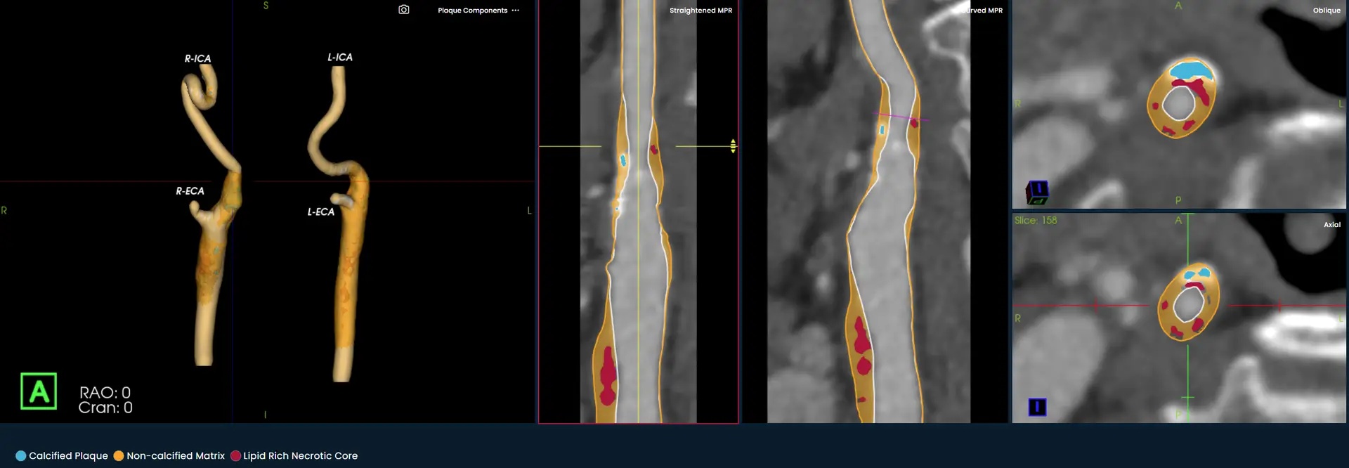 Elucid carotid analysis interface showing a three-dimensional artery and cross-sectional plaque views