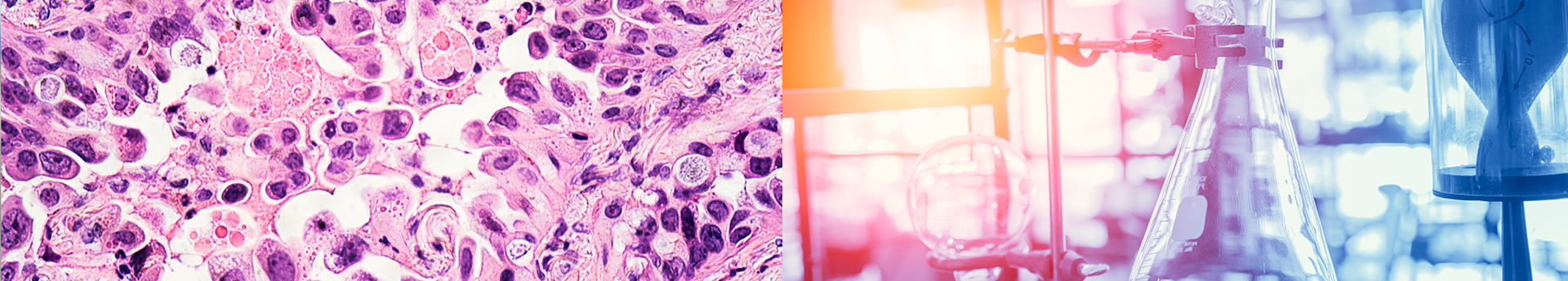 Cancer cells under a microscope beside laboratory glassware