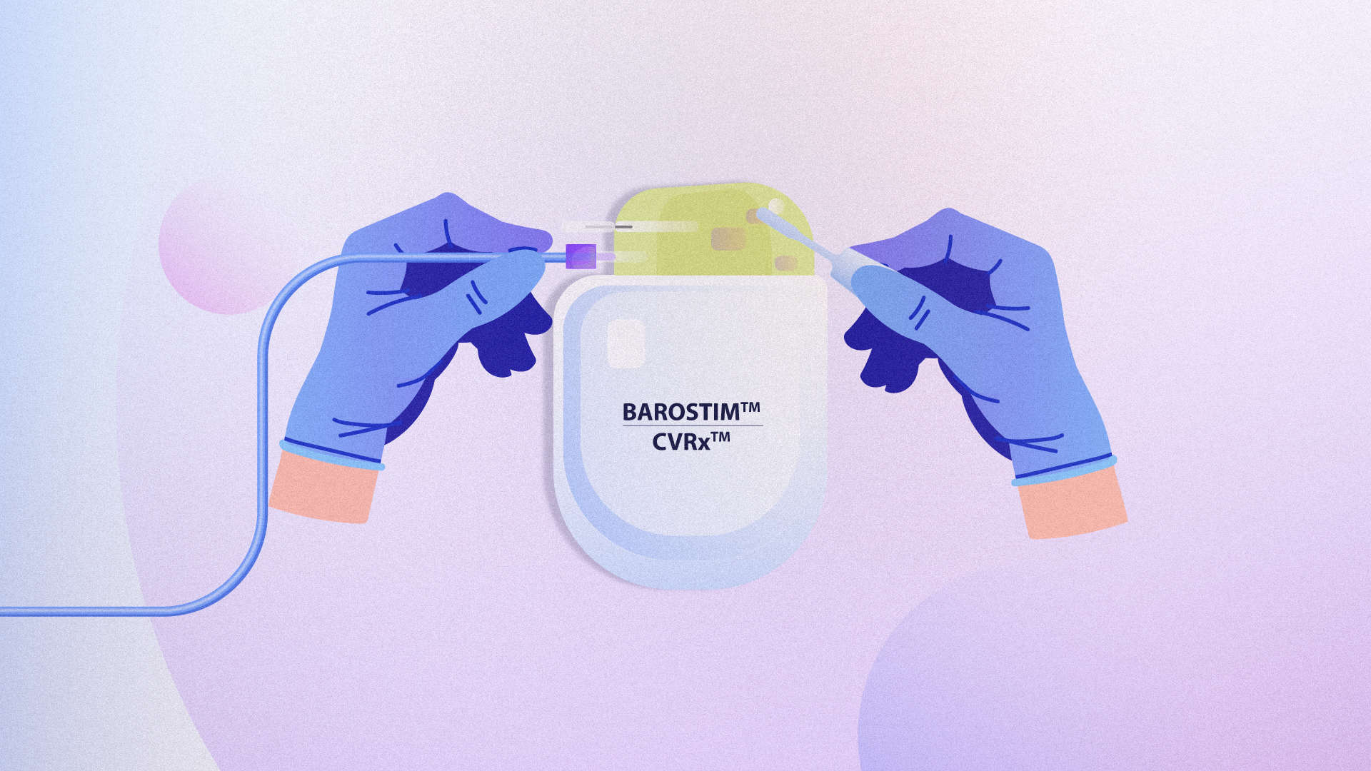 INOVIT animation still showing gloved hands connecting a Barostim implant