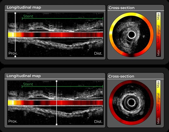 Intravascular Imaging Incorporated (i3)