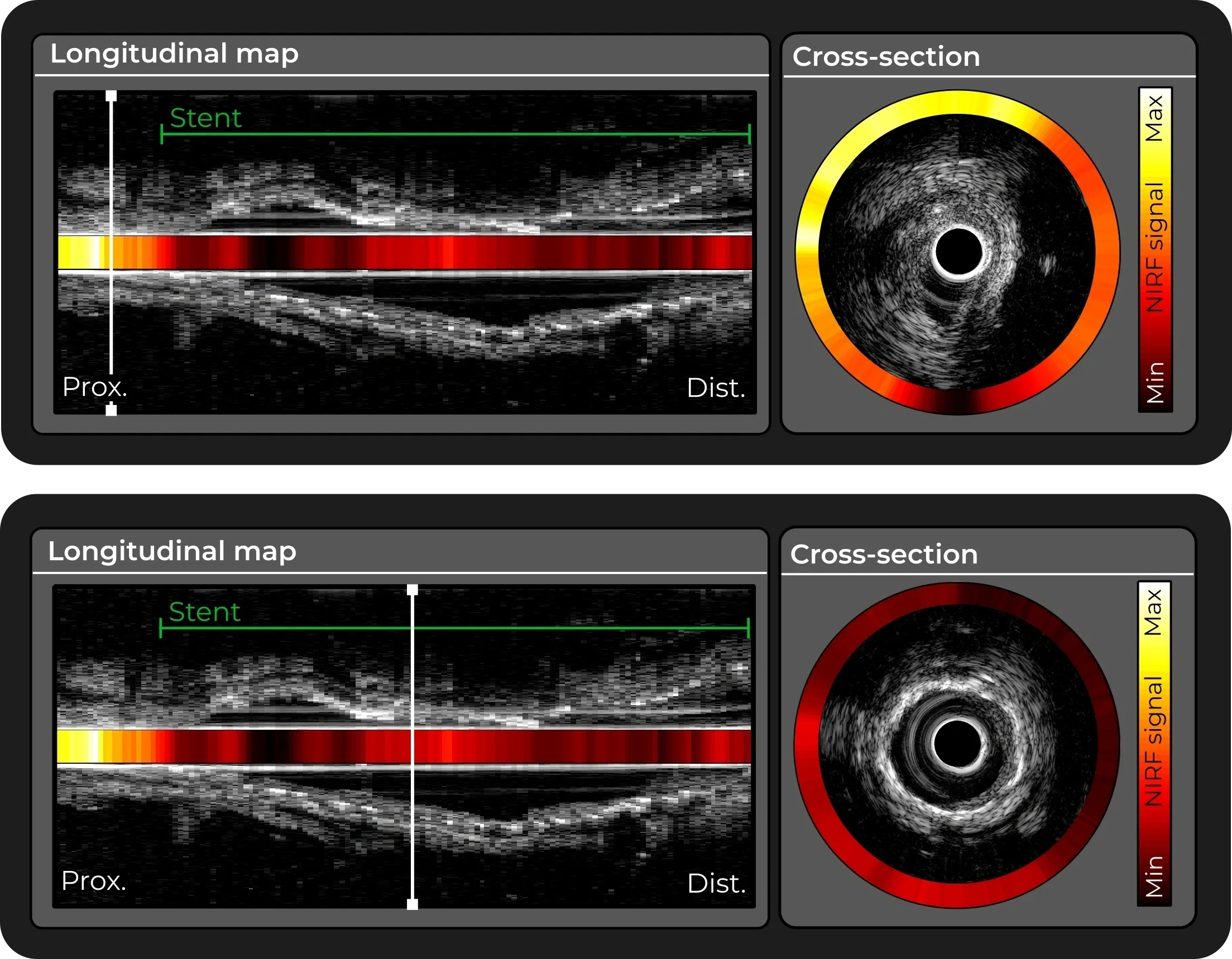 i3 NIRF-IVUS imaging display showing longitudinal maps and cross-sections of a coronary artery with a near-infrared fluorescence signal overlay