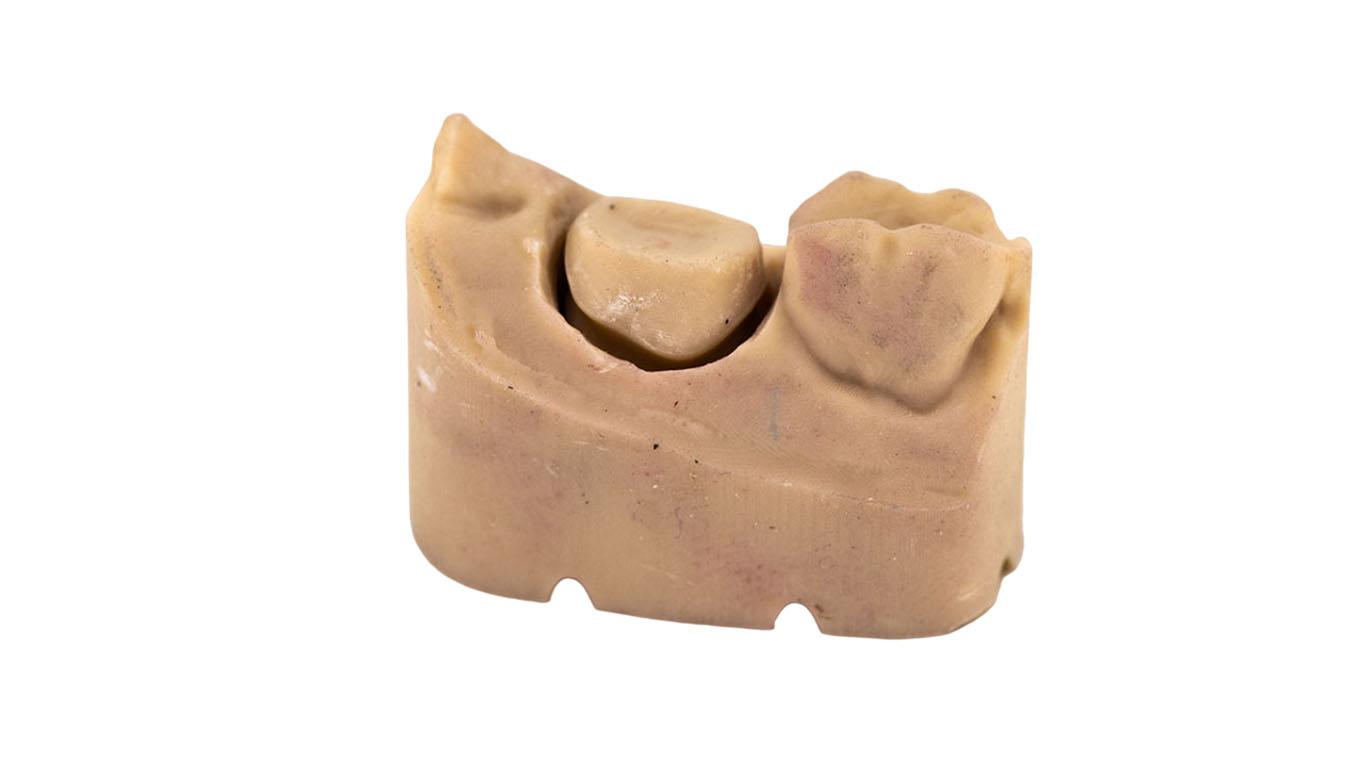 Leixir modelless crown displayed with adjacent teeth