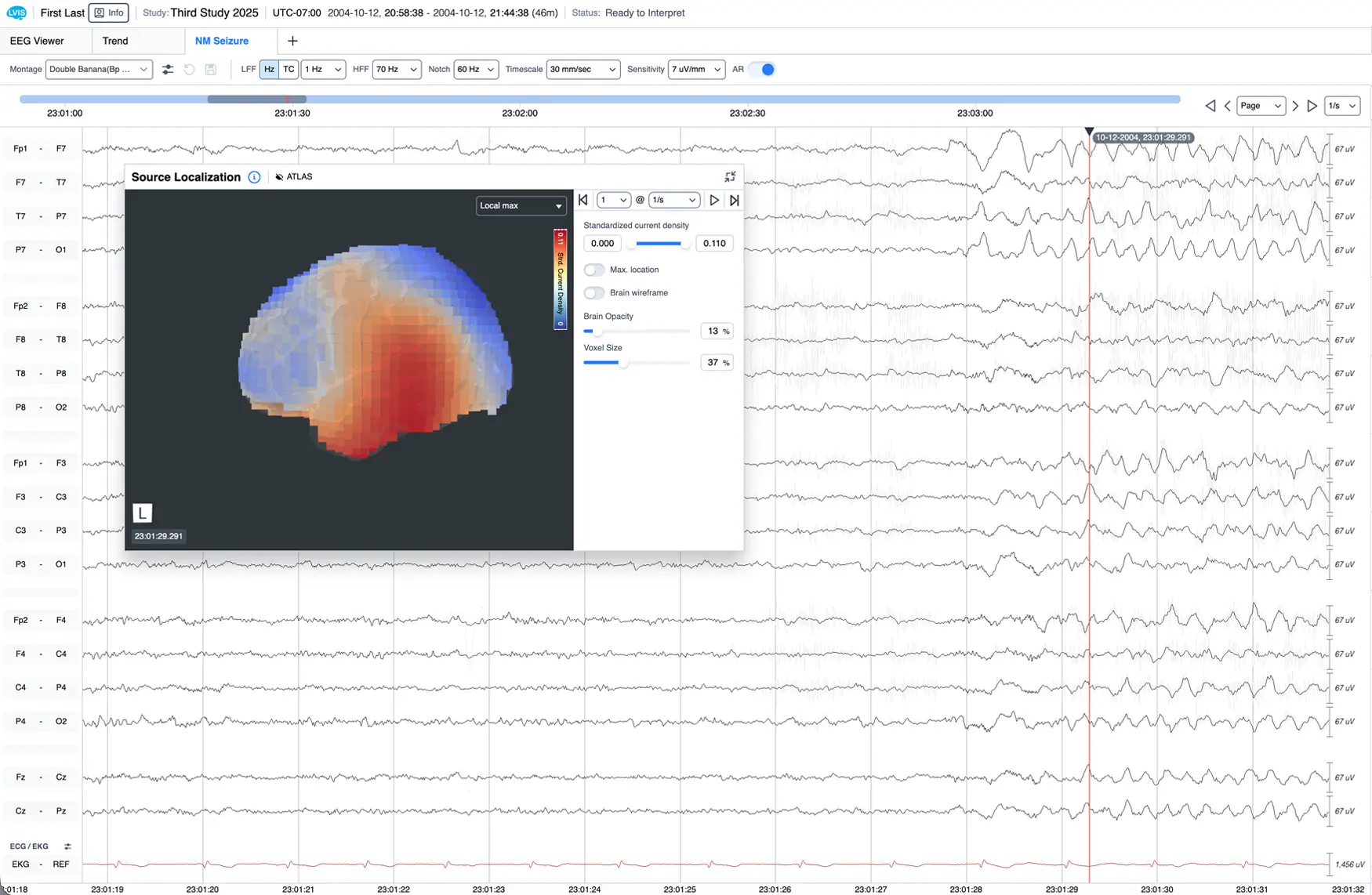 LVIS product illustration showing NeuroMatch brain-source visualization on a laptop