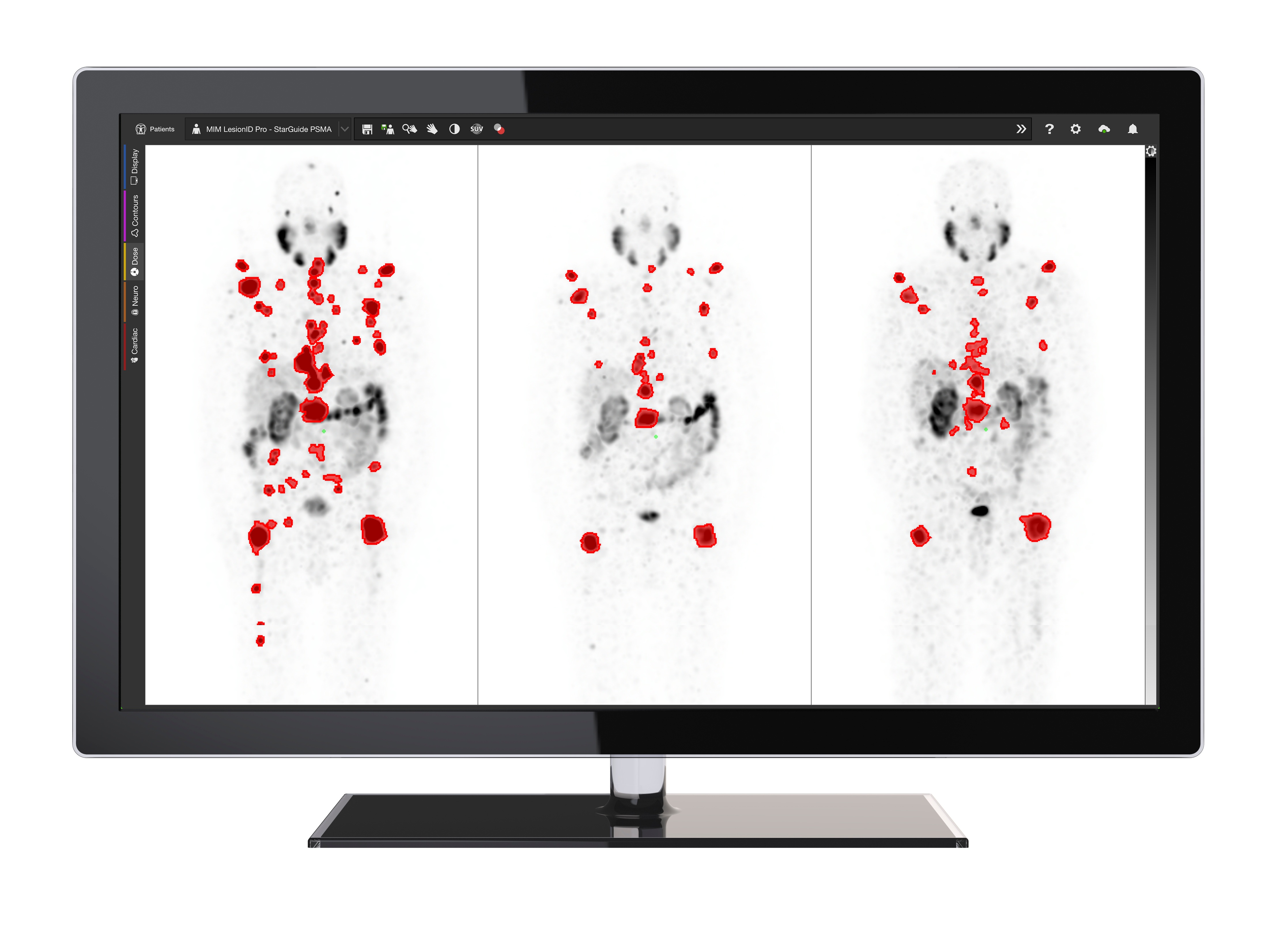 MIM product illustration showing three PET scan views with red segmented regions on a monitor