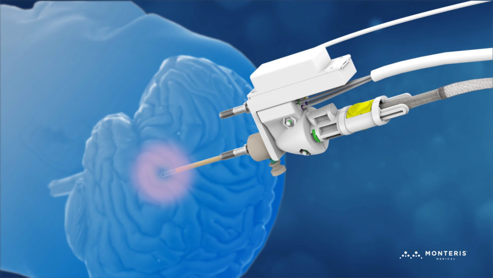 NeuroBlate probe and robotic driver illustrated against a translucent brain model