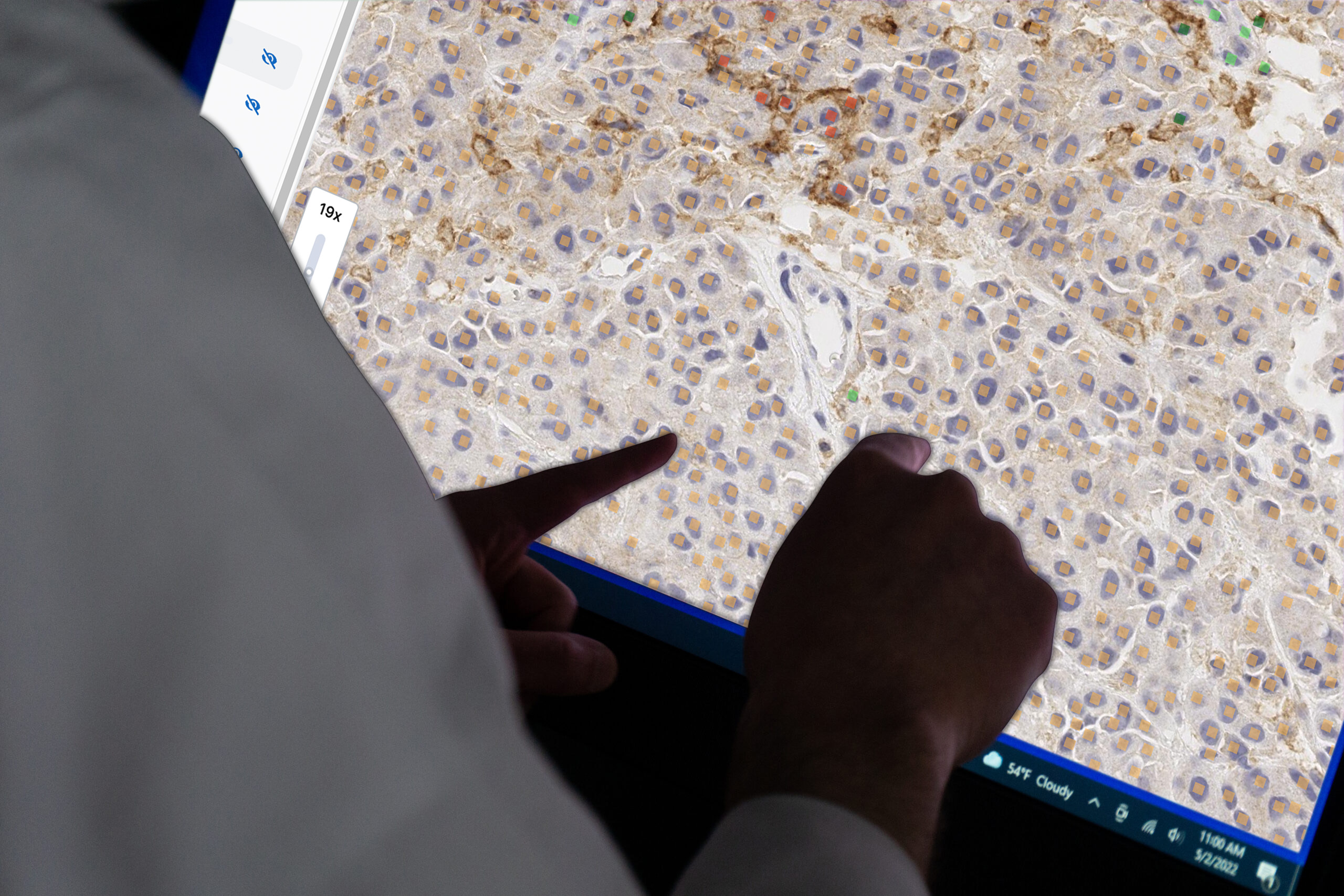 A person reviewing a digitally displayed tissue image with colored cell-analysis overlays