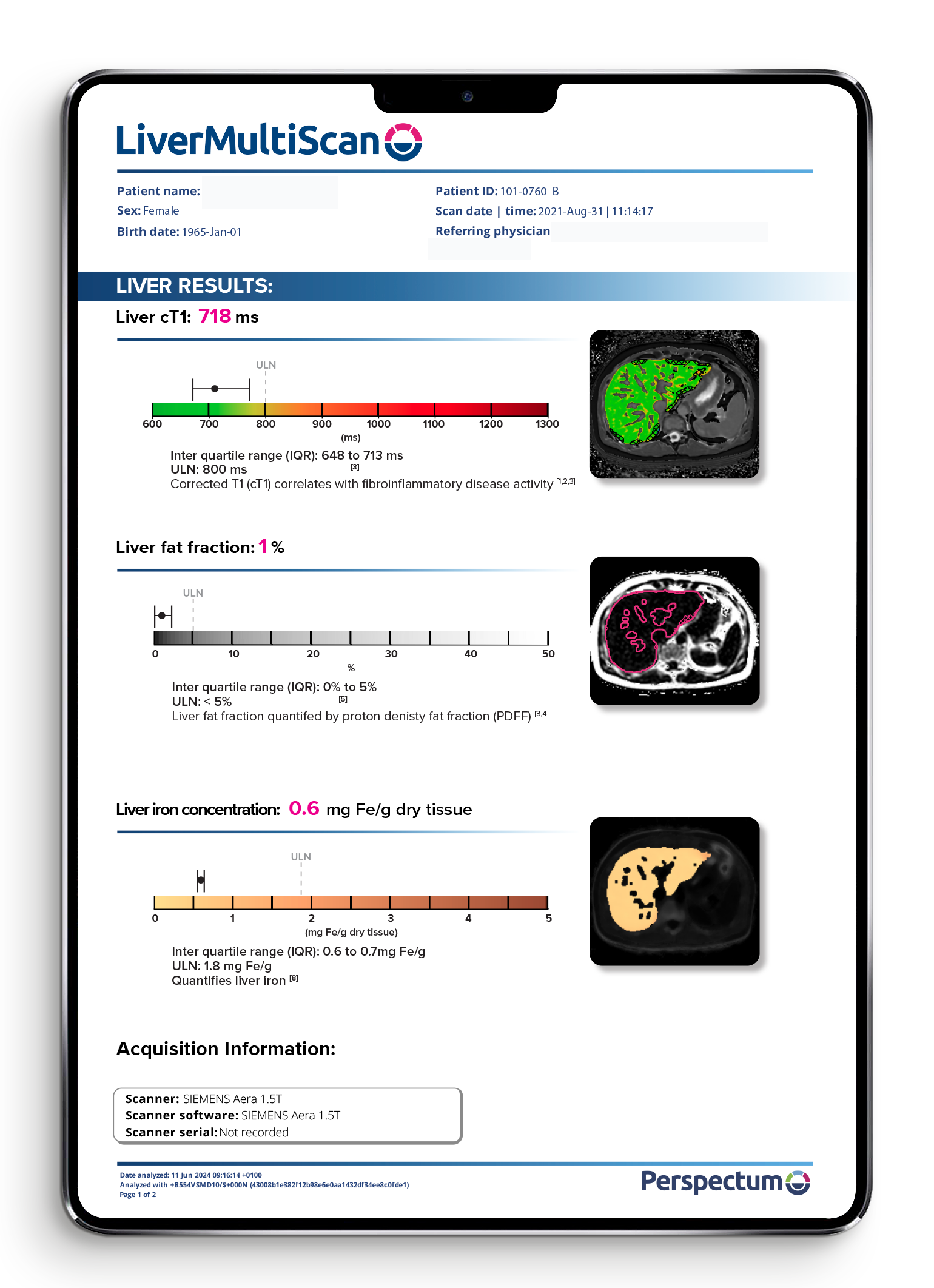 Perspectum LiverMultiScan example report with quantitative liver maps
