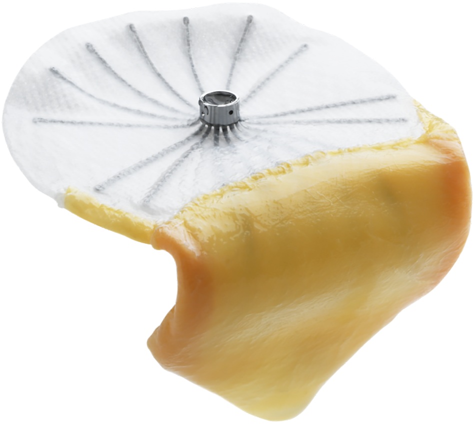 Close view of the MRace posterior leaflet restoration implant