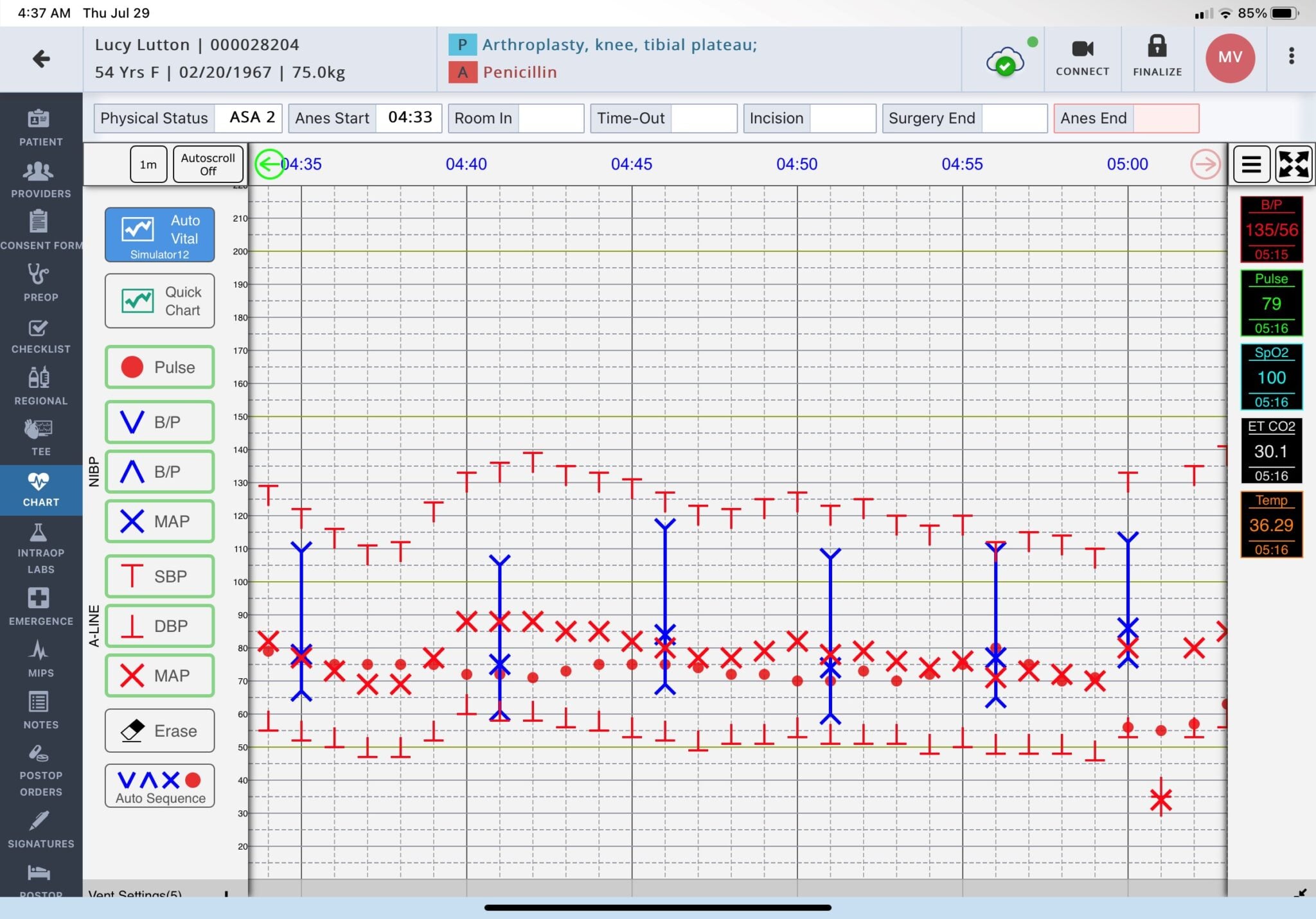 Provation iPro product screenshot showing an anesthesia chart with vital-sign trends