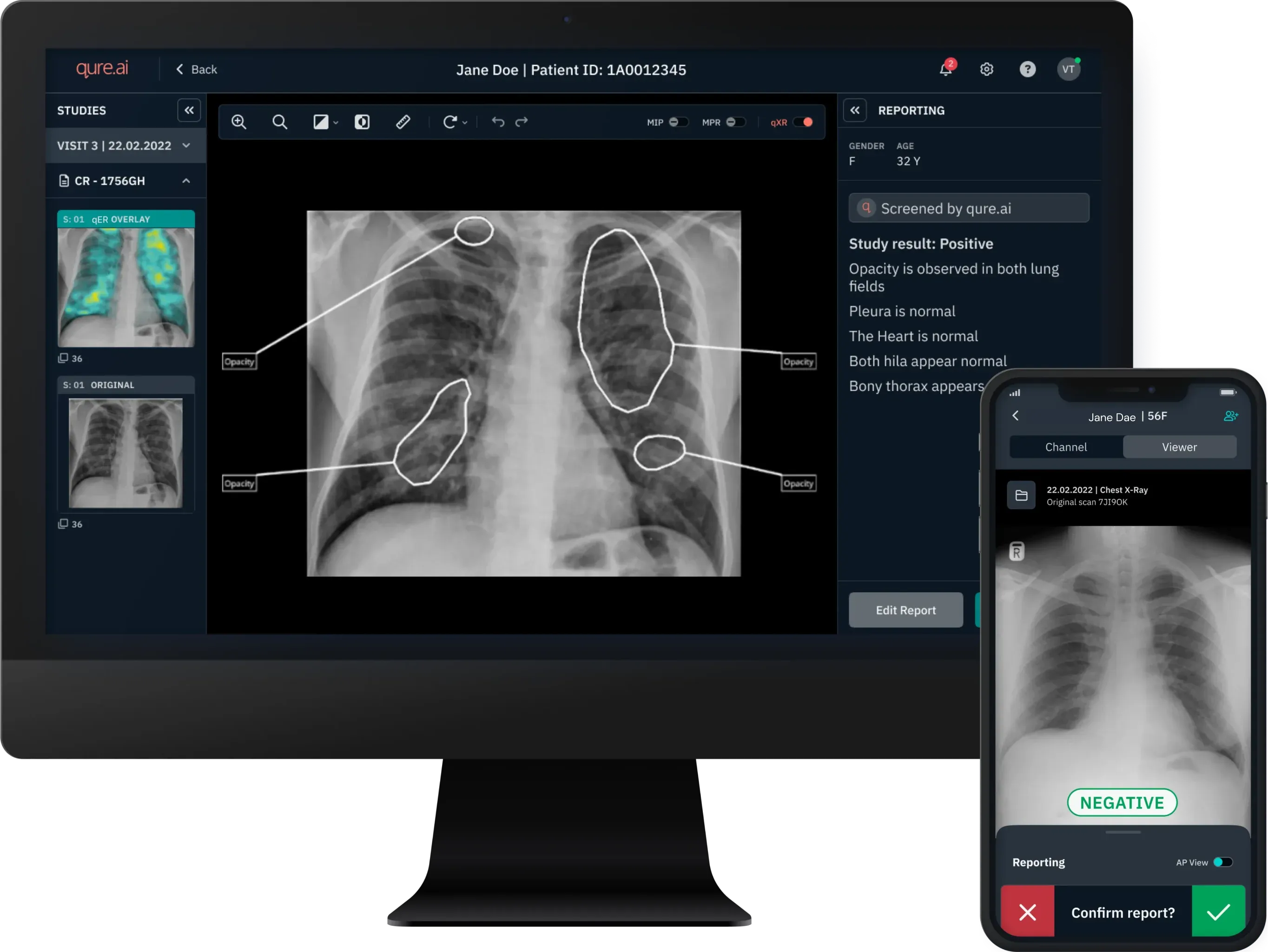 Qure.ai qXR product interface showing a chest X-ray with highlighted regions and a report panel