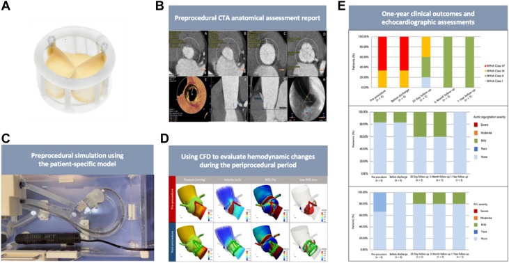 Published Silara research figure showing the valve, patient imaging, a printed aortic root, simulation and follow-up measurements