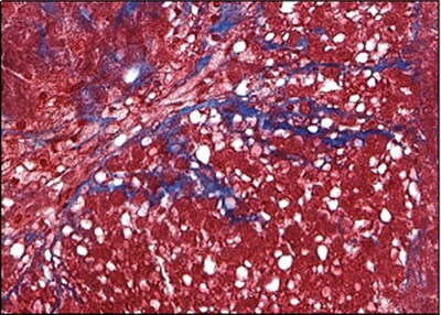 Microscopy image of Viscient bioprinted liver tissue showing MASH disease